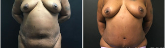 abdominoplasty-fat-transfer-to-breasts-sugery-nyc-before-after-1-1