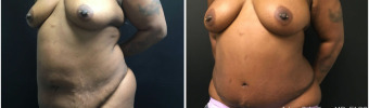 abdominoplasty-fat-transfer-to-breasts-sugery-nyc-before-after-1-2