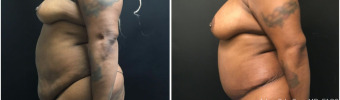 abdominoplasty-fat-transfer-to-breasts-sugery-nyc-before-after-1-5