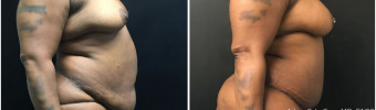 abdominoplasty-fat-transfer-to-breasts-sugery-nyc-before-after-1-4