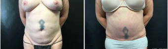 abdominoplasty-sugery-nyc-before-after-1-1