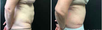 abdominoplasty-sugery-nyc-before-after-1-5