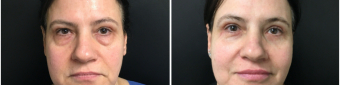 blepharoplasty-sugery-nyc-before-after-1-1