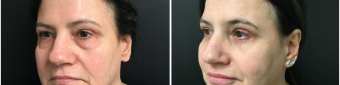 blepharoplasty-sugery-nyc-before-after-1-2