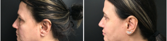 blepharoplasty-sugery-nyc-before-after-1-4