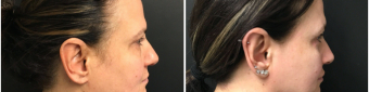 blepharoplasty-sugery-nyc-before-after-1-5