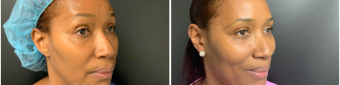 blepharoplasty-sugery-nyc-before-after-2-3