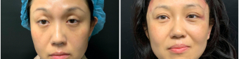 blepharoplasty-sugery-nyc-before-after-3-1