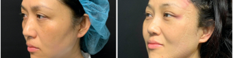 blepharoplasty-sugery-nyc-before-after-3-2