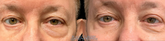 st-eye-surgery-blepharoplasty-plastic-surgery-nyc-before-after-1-1