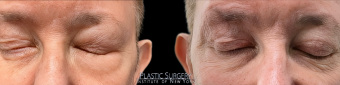 st-eye-surgery-blepharoplasty-plastic-surgery-nyc-before-after-1-2