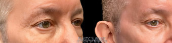st-eye-surgery-blepharoplasty-plastic-surgery-nyc-before-after-1-3