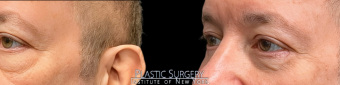 st-eye-surgery-blepharoplasty-plastic-surgery-nyc-before-after-1-4