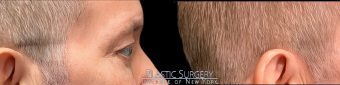 st-eye-surgery-blepharoplasty-plastic-surgery-nyc-before-after-1-5