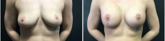 breast-augmentation-mastopexy-surgery-nyc-before-after-1-1