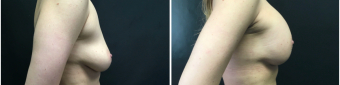 breast-augmentation-mastopexy-surgery-nyc-before-after-1-5