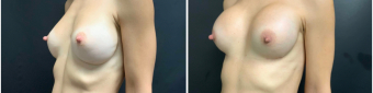 breast-augmentation-mastopexy-surgery-nyc-before-after-2-2