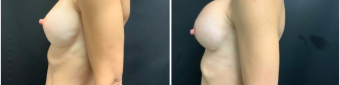 breast-augmentation-mastopexy-surgery-nyc-before-after-2-4