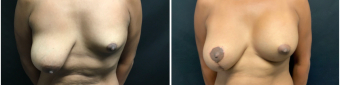 breast-augmentation-mastopexy-surgery-nyc-before-after-3-1