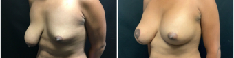 breast-augmentation-mastopexy-surgery-nyc-before-after-3-2
