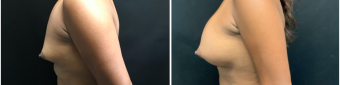 breast-augmentation-mastopexy-surgery-nyc-before-after-3-4