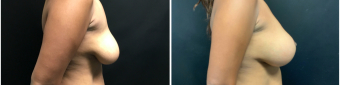 breast-augmentation-mastopexy-surgery-nyc-before-after-3-5