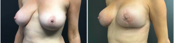 breast-augmentation-mastopexy-surgery-nyc-before-after-4-2