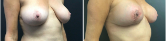 breast-augmentation-mastopexy-surgery-nyc-before-after-4-3