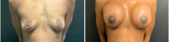 breast-augmentation-mastopexy-surgery-nyc-before-after-5-1