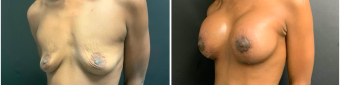 breast-augmentation-mastopexy-surgery-nyc-before-after-5-2