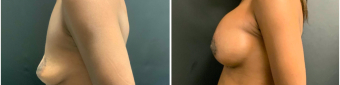 breast-augmentation-mastopexy-surgery-nyc-before-after-5-4