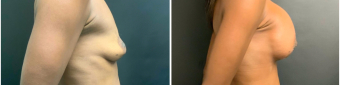 breast-augmentation-mastopexy-surgery-nyc-before-after-5-5