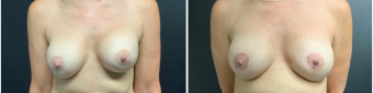 breast-augmentation-mastopexy-surgery-nyc-before-after-6-1