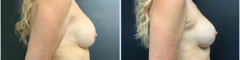 breast-augmentation-mastopexy-surgery-nyc-before-after-7-1