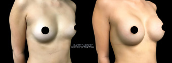 am-breast-augmentation-plastic-surgery-nyc-before-after-1-2