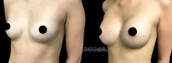 am-breast-augmentation-plastic-surgery-nyc-before-after-1-3