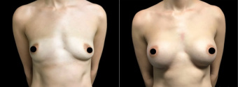 amg-breast-augmentation-plastic-surgery-nyc-before-after-1-1