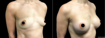 amg-breast-augmentation-plastic-surgery-nyc-before-after-1-2