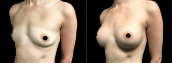 amg-breast-augmentation-plastic-surgery-nyc-before-after-1-3