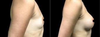 amg-breast-augmentation-plastic-surgery-nyc-before-after-1-4