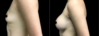 amg-breast-augmentation-plastic-surgery-nyc-before-after-1-5