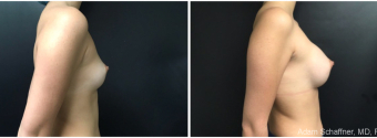 breast-augmentation-sugery-nyc-before-after-1-3