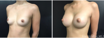 breast-augmentation-sugery-nyc-before-after-1-4