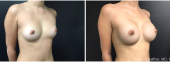 breast-augmentation-sugery-nyc-before-after-1-5