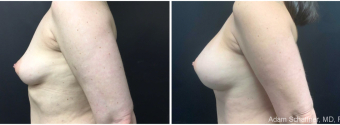 breast-augmentation-sugery-nyc-before-after-2-3