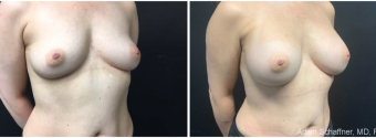 breast-augmentation-sugery-nyc-before-after-2-4