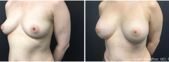 breast-augmentation-sugery-nyc-before-after-2-5