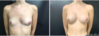 breast-augmentation-sugery-nyc-before-after-3-1