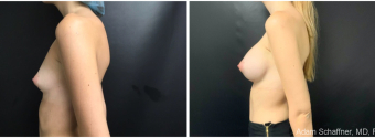 breast-augmentation-sugery-nyc-before-after-3-3