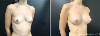 breast-augmentation-sugery-nyc-before-after-3-4